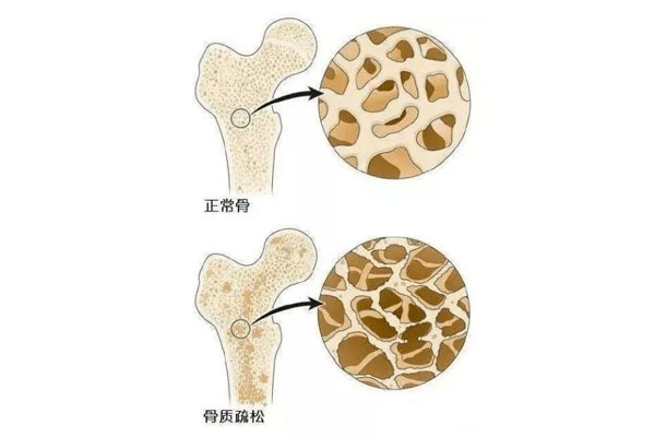 骨质松散,骨质松散的体现