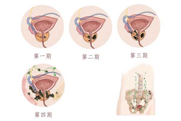 前线腺癌