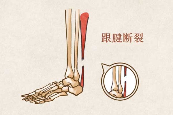 跟腱断裂,跟腱断裂的治疗